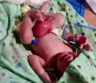 धनकुटाकी १८ बर्षीया युवतीले जन्माइन् आन्द्राभुँडी बाहिरै भएको बच्चा