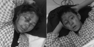 होली खेल्दा खेल्दै पानी ठानेर एसिड अनुहारमा दलेपछि