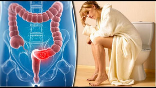 के कारणले हुन्छ पायल्स ? यस्ता छन् निको पार्ने घरेलु उपाय