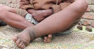 फागुन २८ देखि हात्तीपाइलेविरुद्धको औषधि खुवाइने