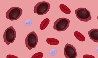 सिकलसेल एनेमियाका बिरामीको निःशुल्क उपचार माग