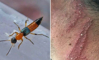 इलाममा पनि ‘नाइरोबी फ्लाइ’का सङ्क्रमित फेला