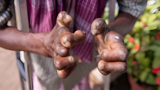 बाँकेमा एक सय ४६ जनामा कुष्ठरोग