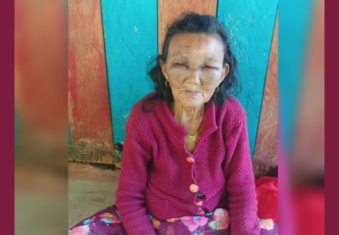 छोरी–ज्वाइँको कुटपिटबाट ८० वर्षीया वृद्धा आमा घाइते